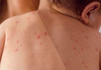 La intensa movilidad de BCS pone en riesgo ante brotes de sarampión en el país